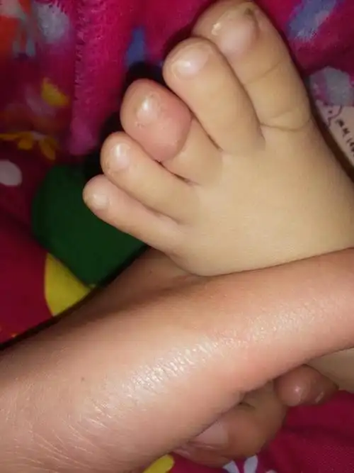 一岁三个月的宝宝,脚趾不知道是什么东西给缠的,伤口很深,又红又肿的