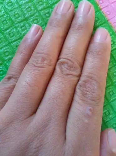 给女儿洗尿布洗的手上长了三个瘊子~怎么去掉它呢