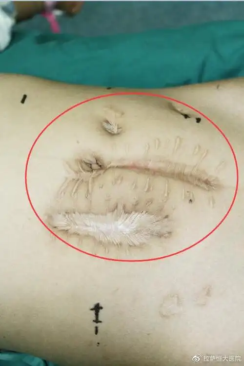 医患真情精准开展微创腹腔镜手术获患者哈达致谢