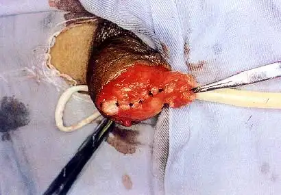 用4号丝线缝合阴茎海绵体断端,尿道内置气囊导尿管.