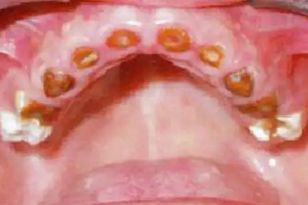 如果牙齿长期处于酸性环境,就会发生脱钙,也就是蛀牙.