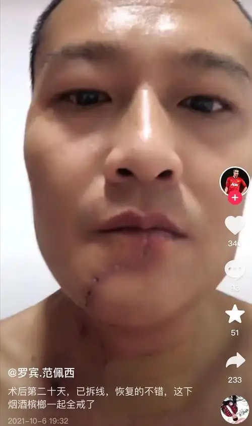 "槟榔四巨头":一天吃5包槟榔,两年死仨,剩下一个割舌保命