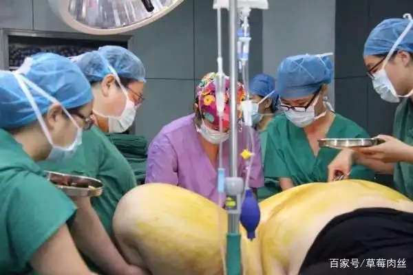 扒开"层层脂肪"才找到胎儿的头,最胖产妇生孩子,医生:体力活