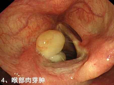 照片,喉部肿物分为良性肿物和恶性肿物,常见的良性肿物有喉乳头状瘤