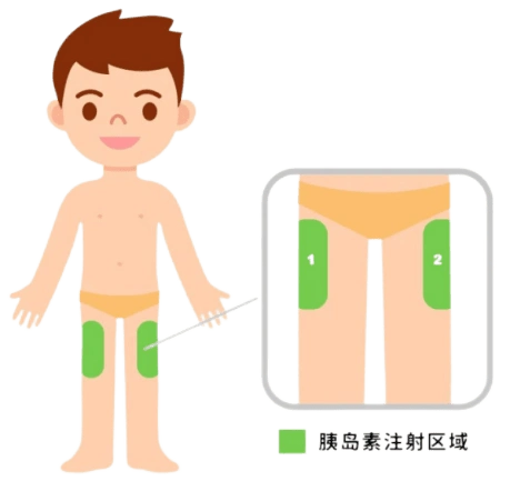 大腿内侧的血管,神经较为丰富,因此选择大腿外侧进行注射,但此部位的