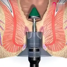痔疮的手术过程-健康视频-搜狐视频