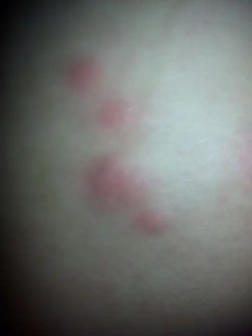 有十多个,痒痒的,感觉像上蚊子咬的,但肯定不是蚊子咬的,不知道是什么