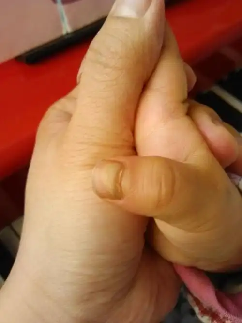 三周岁女宝宝的右手拇指指甲分层长,是怎么回事儿呢?