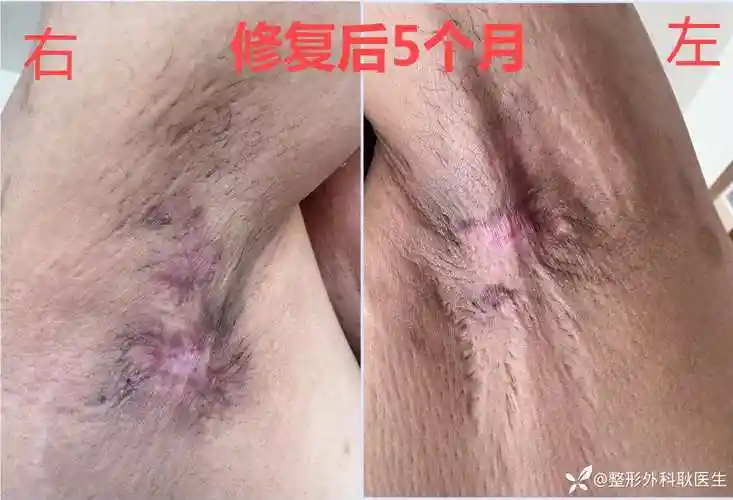 花了近2个w做的腋臭,最后却皮片全层坏死!启动创面修复.