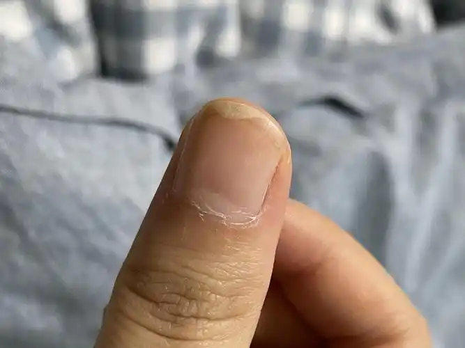 我的指甲又分层了