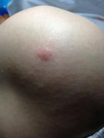 虫咬性皮炎图片 (109)_有来医生