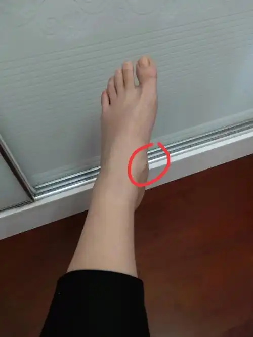 脚崴后脚内侧有块骨头突出来了