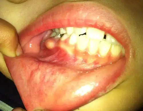 孩子牙床上长脓包图片