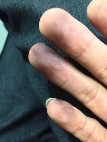 手指发紫是怎么回事?