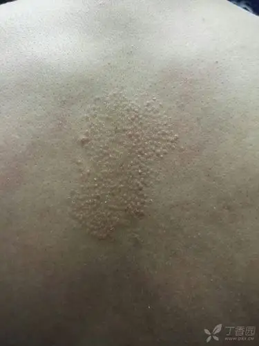 湿疹? - 皮肤与性传播疾病讨论版 -丁香园论坛