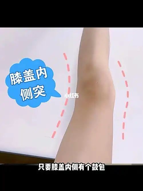 高效改善膝盖内侧突出