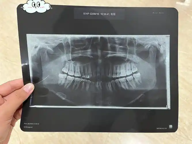 07牙齿根管治疗日记