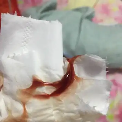 孕35周4,晚上阴道突然流出褐色果冻状的分泌物,肚子不疼,除了大腿根疼