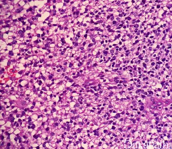 间变性少突胶质细胞瘤