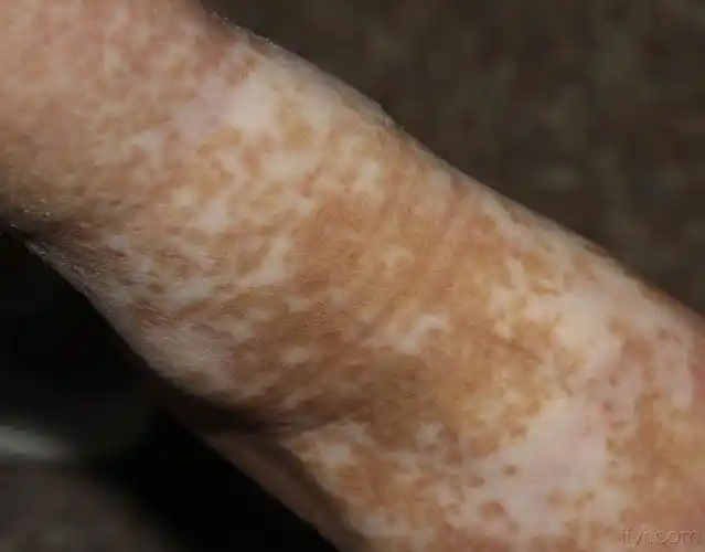 色素性皮肤病(3)