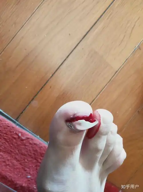 拔指甲是什么样的体验?很疼么? - 知乎