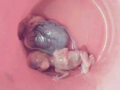 胎儿也是生命,堕胎是会有报应的,震撼