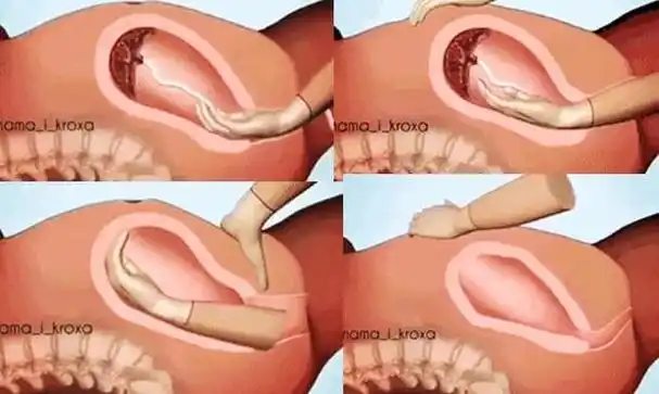 谁说第三产程不疼几位宝妈分享的手剥胎盘之痛比顺产还疼