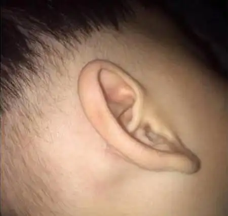 【淋巴】_淋巴结肿大_淋巴瘤_亲亲宝贝网