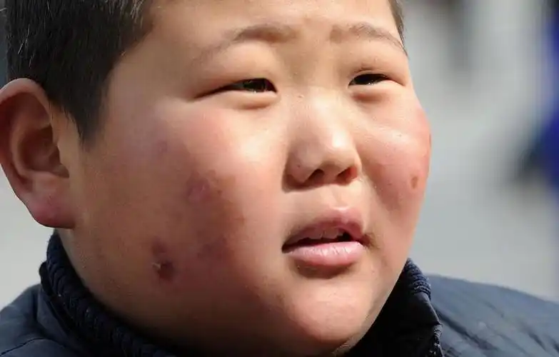 一个冬天下来,小召均的脸上多处冻疮.(郑州晚报 常亮/摄)