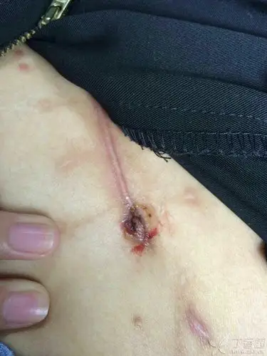 普通外科 帖子详情四个月前开的阑尾,急性化脓性阑尾炎,当时阑尾炎症