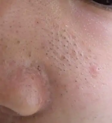 学生党鼻子上黑头多怎么办,学生党如何去黑头