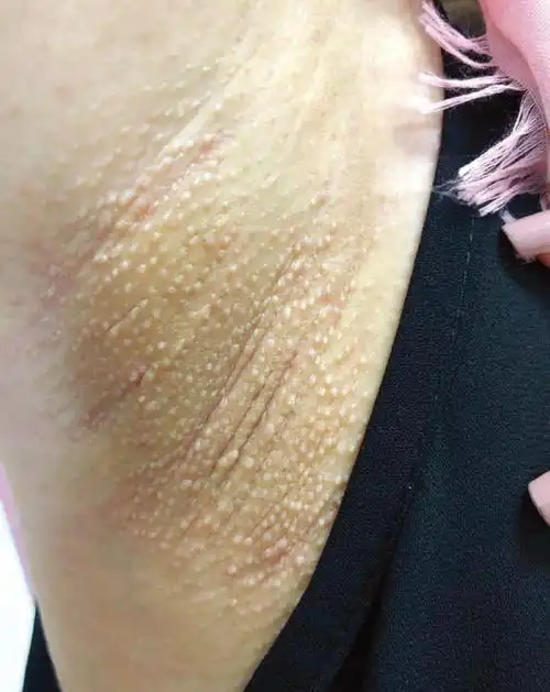 皮肤科检查示双侧腋窝多发,肤色,毛囊性丘疹,直径 2～3 mm(图 1).