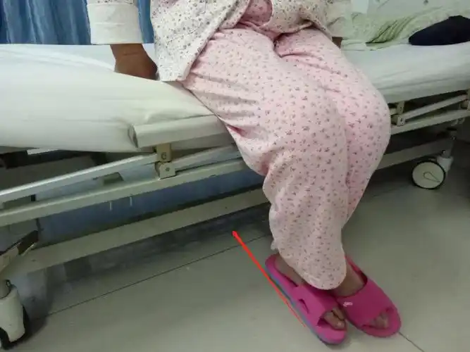 床边压腿训练  方法:坐床沿,健侧小腿压术侧小腿,使膝关节屈曲,频次