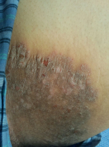 体股癣初期现象图片 (11)