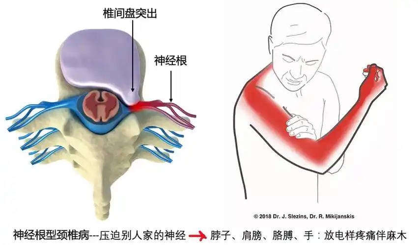 神经根型:颈椎椎间盘突出压迫外部(椎间盘外)的神经根,出现脖子,及蝌