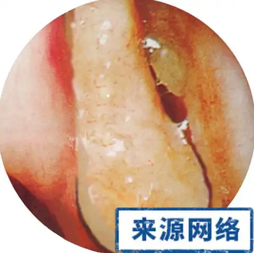 鼻息肉症状图片