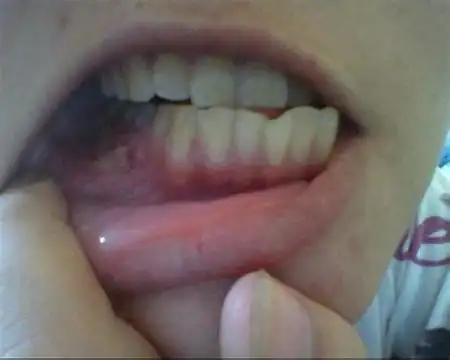 牙龈炎图片及症状图片大全,牙龈出血的特点介绍(和牙龈癌区分)