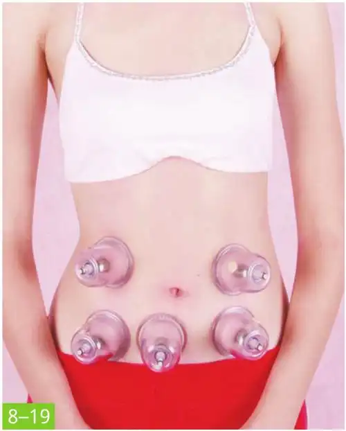 子宫脱垂拔罐治疗