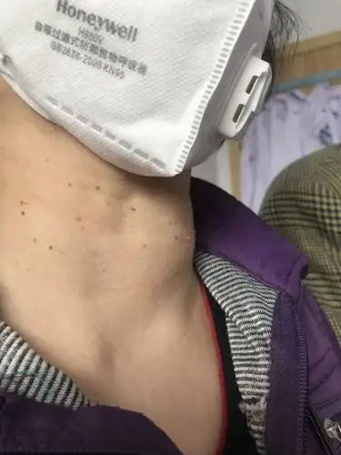 6旬婆婆脖子肿起4公分的