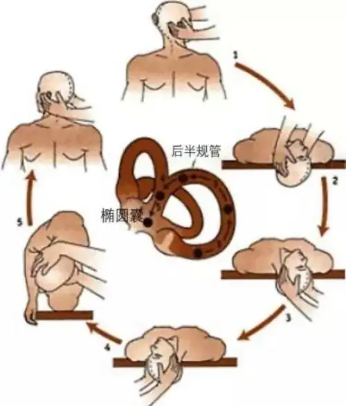 有一种晕叫做"耳石症"_内耳眩晕_介绍_症状表现_治疗方式 - 好大夫