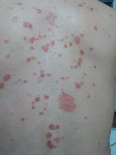 全身起红斑,甚痒,一个月了用药没效果.起皮一层一层的.