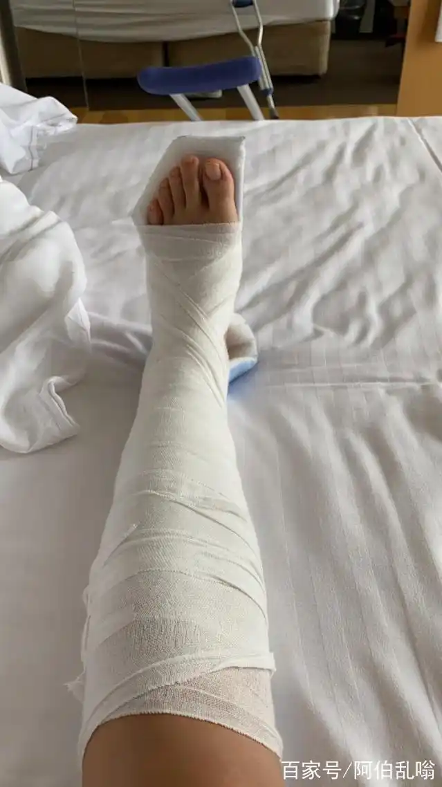"香港新一代玉女"卫诗雅滑雪时发生意外:脚骨裂了五分之四!