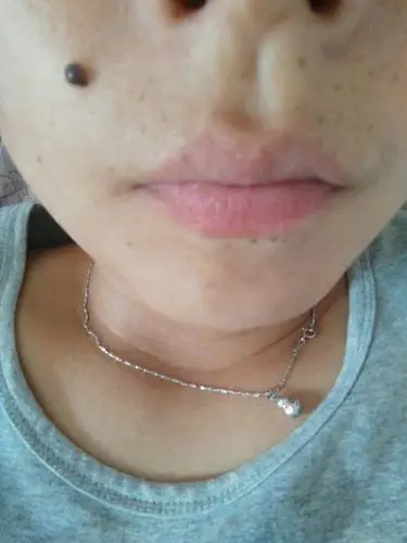 鼻子边的这颗黑痣小时候只是一粒小黑点 最近几年长的这么大 能去除吗