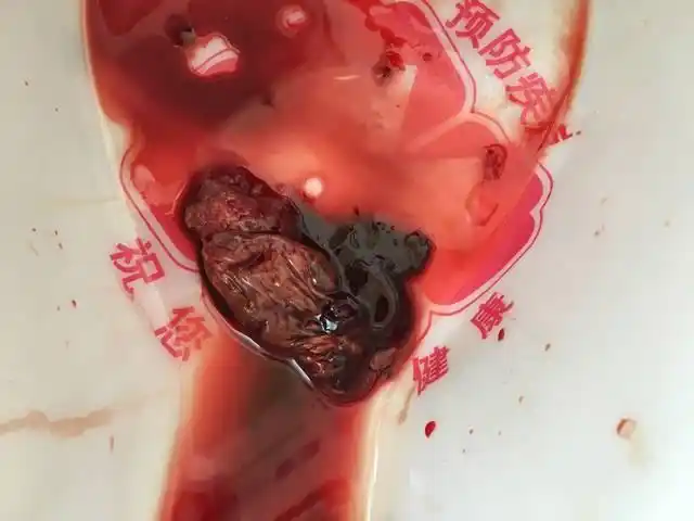 自然流产图片赏析