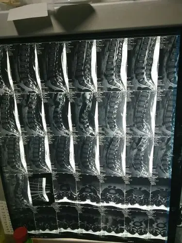 22岁小伙子,两节巨大突出今日成功在衡水市四院南区腰椎间盘突出椎间