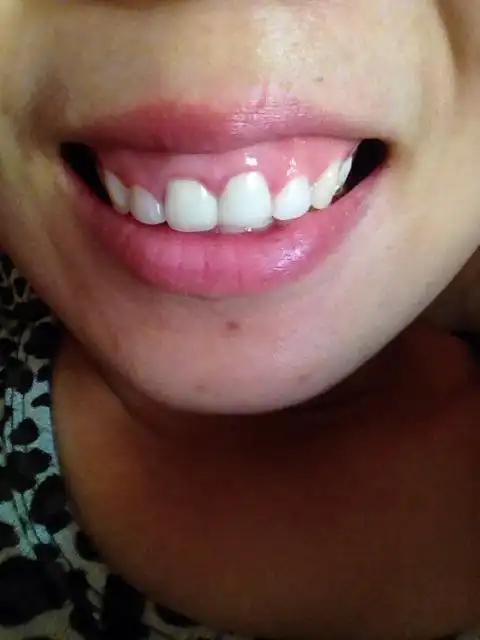 笑露出牙龈,好难看,请问能手术修正吗,和系带有关吗?大概多少钱