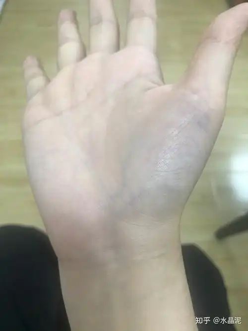 手掌青筋越来越多越明显还延伸到手腕越来越长怎么回事