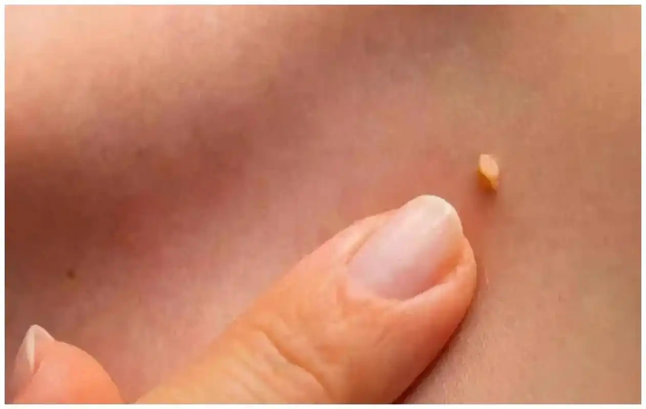 身上4种"小疙瘩",是hpv"信号灯"  1,寻常疣 是最常见的hpv感染的一种