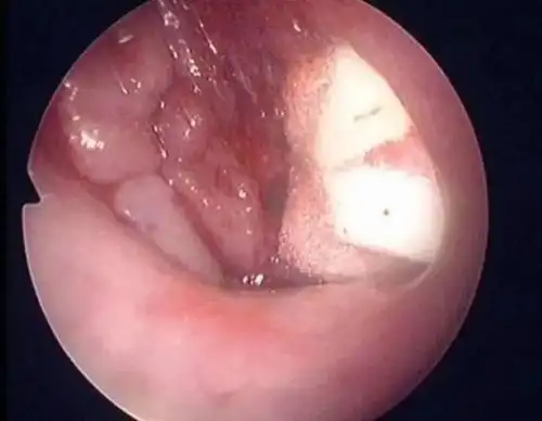 扁桃体肥大也是一样,扁桃体会堵住呼吸道,这会阻碍从鼻腔进入咽喉的