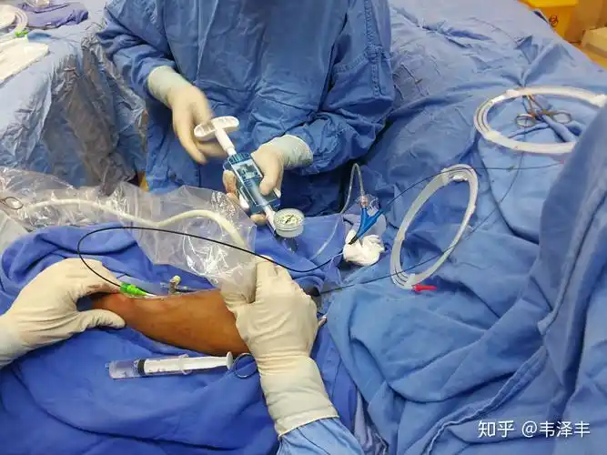 狭窄处扩张后残余狭窄小于30%,血流量875ml/min,溶栓手术成功!